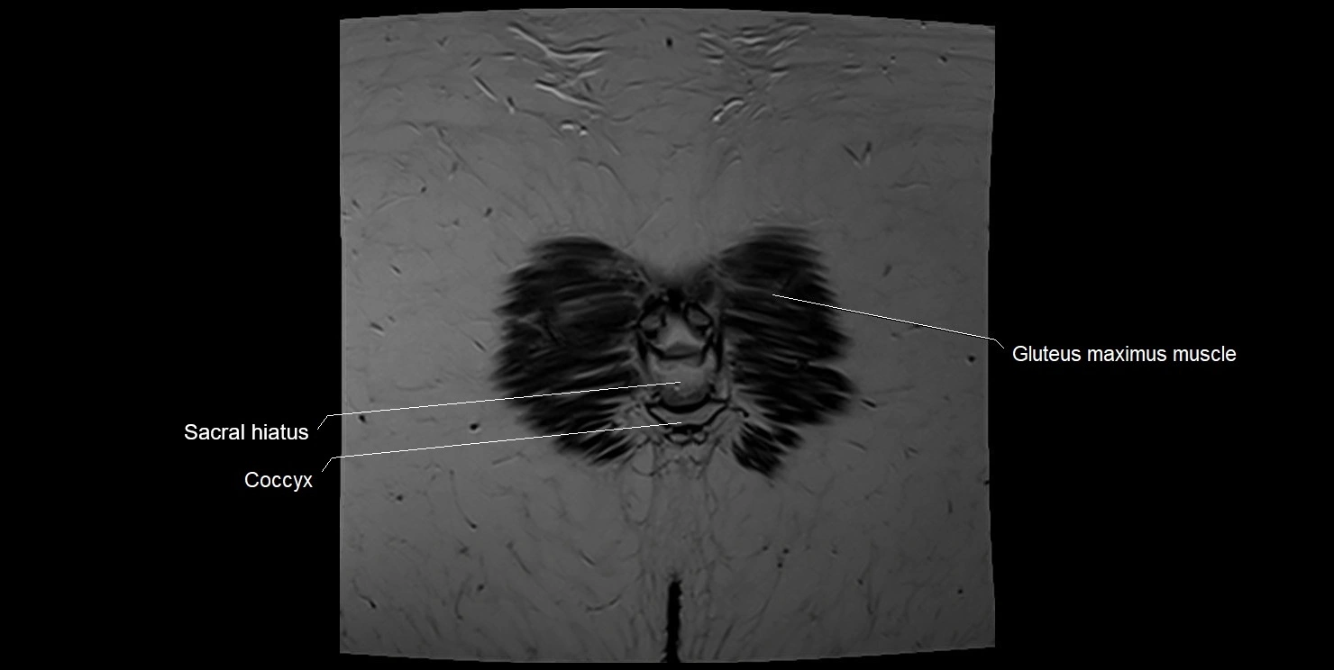 female pelvis coronal cross sectional anatomy image 38.webp